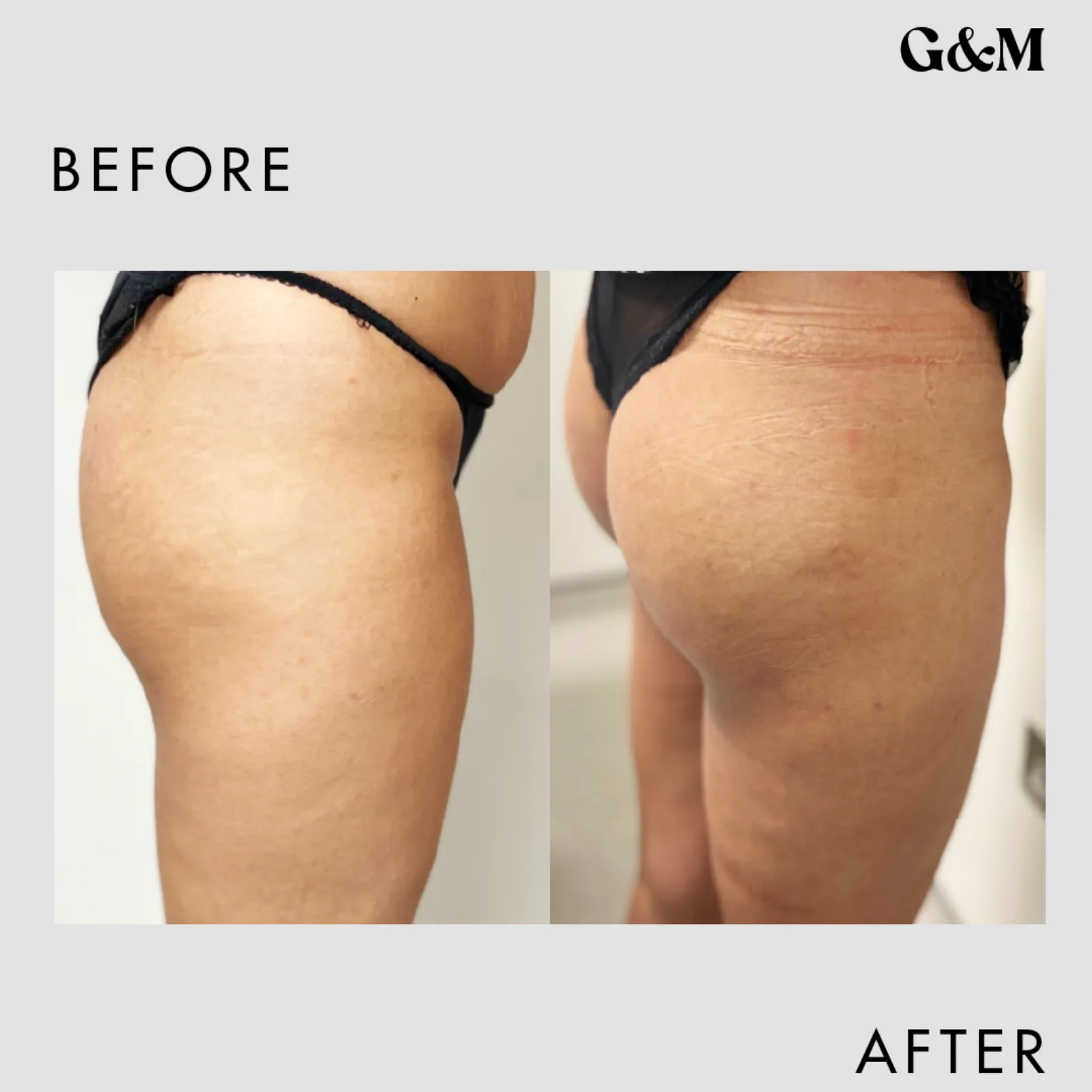 Before and after — Starter — 50ml