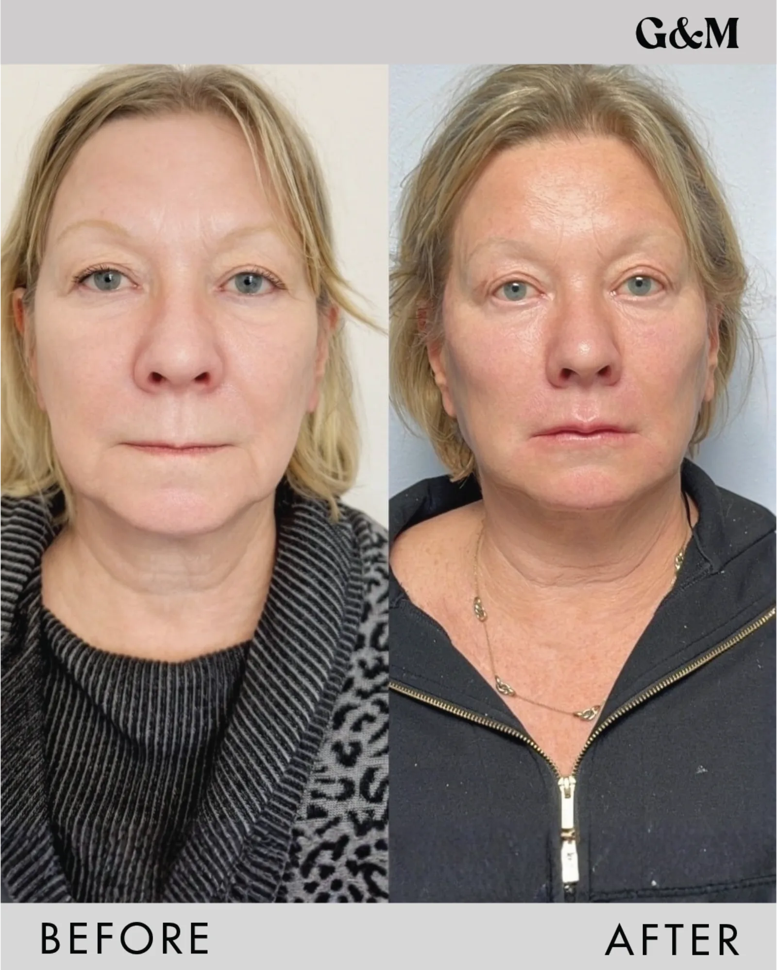 Before and after — PDO Mid and Lower Face — full plan