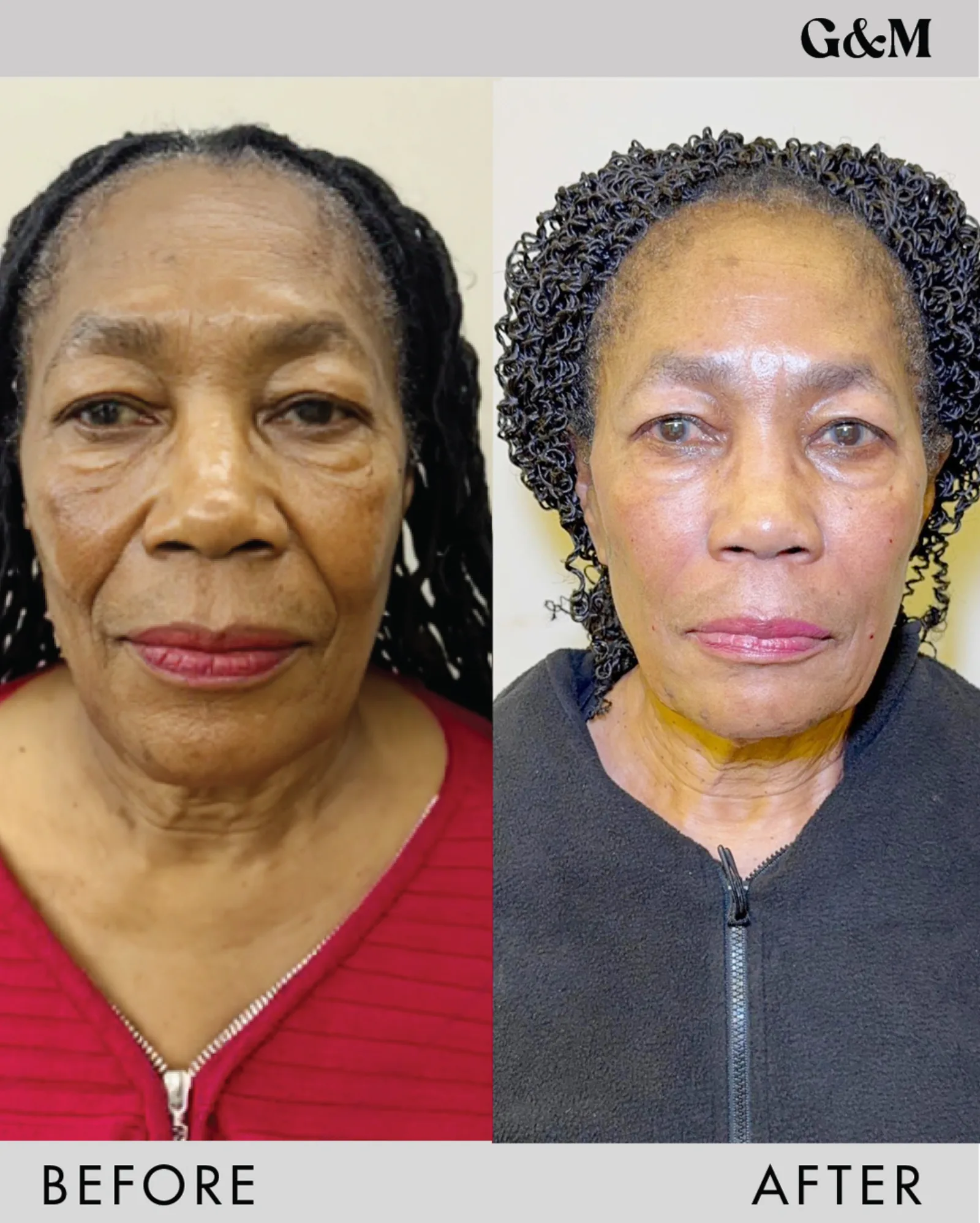 Before and after — full PDO Mid and Lower Face plan