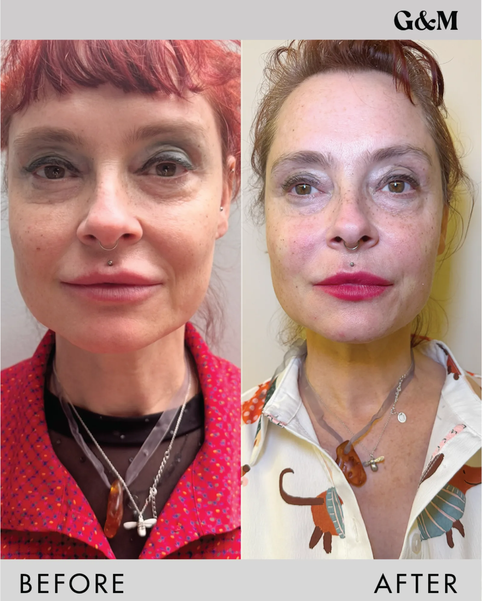 Before and after — PDO Double — cheek + jaw