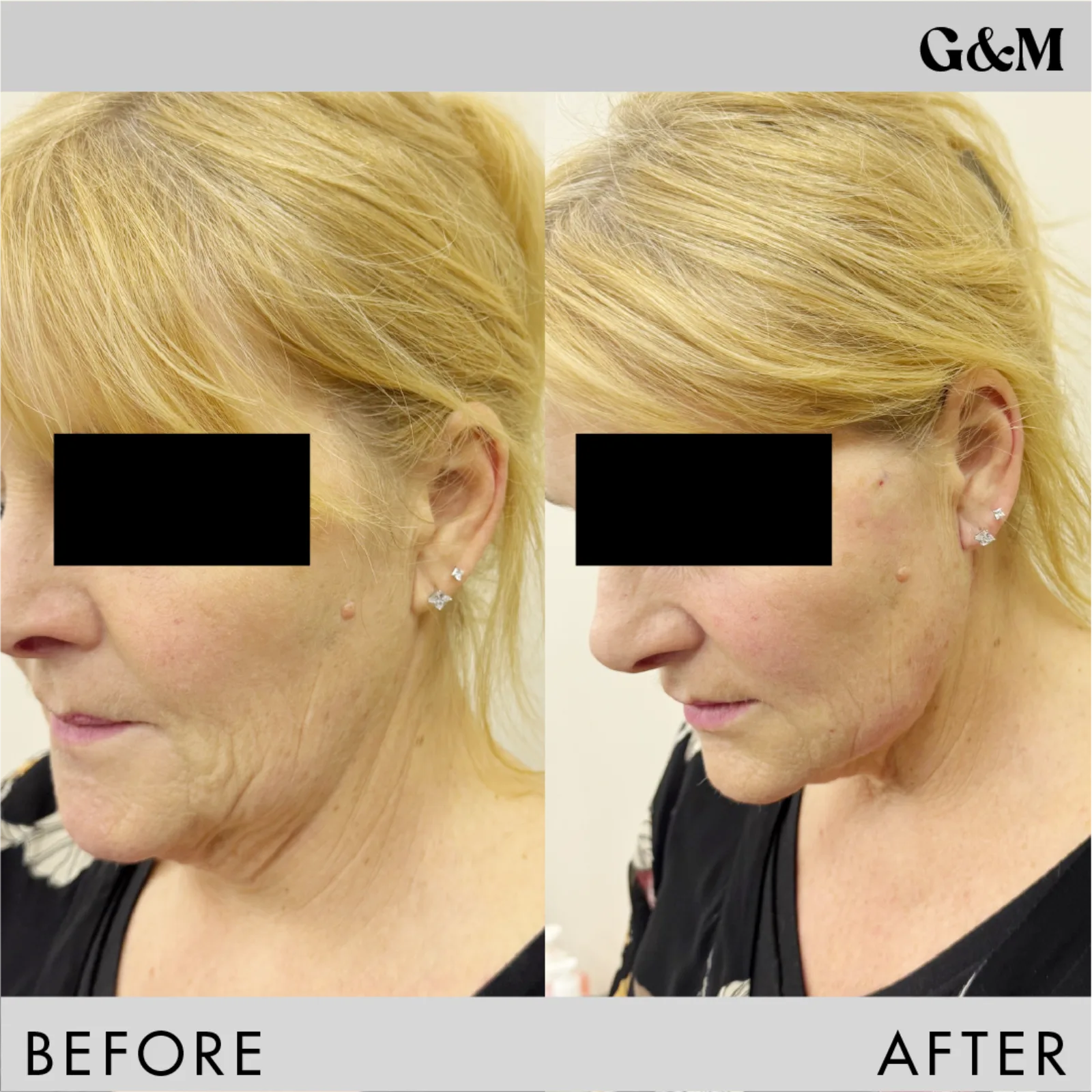 Before and after — PDO Double — jawline focus, profile view