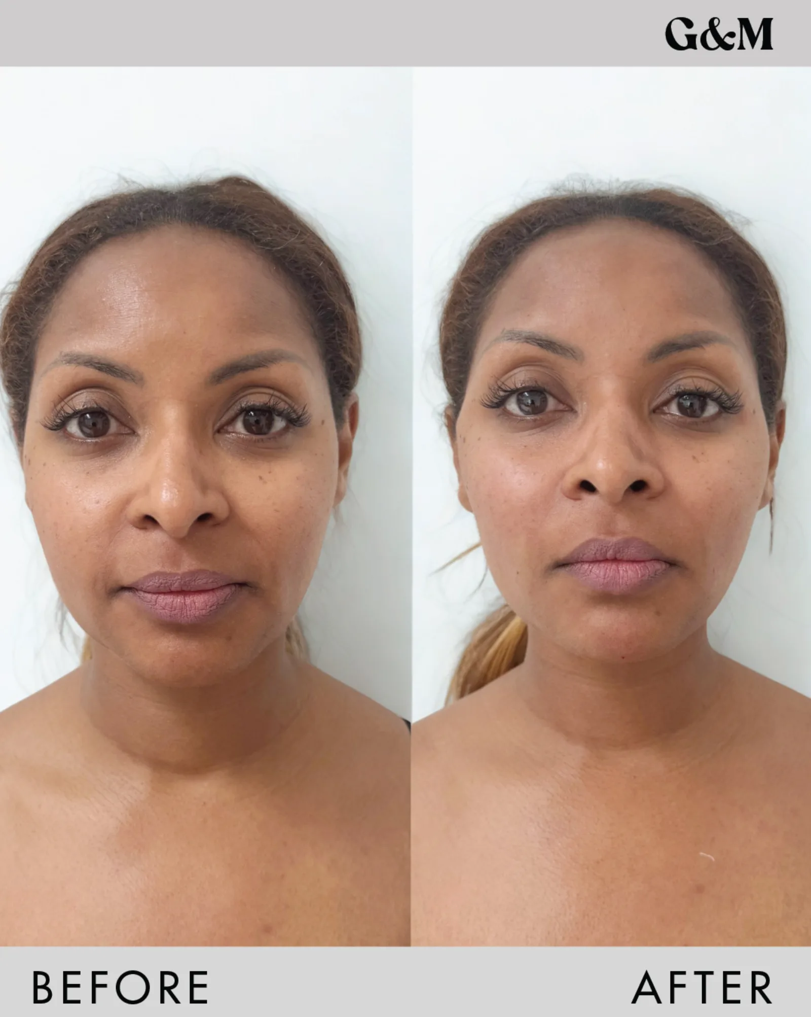 Before and after — PDO Double — cheek + jaw