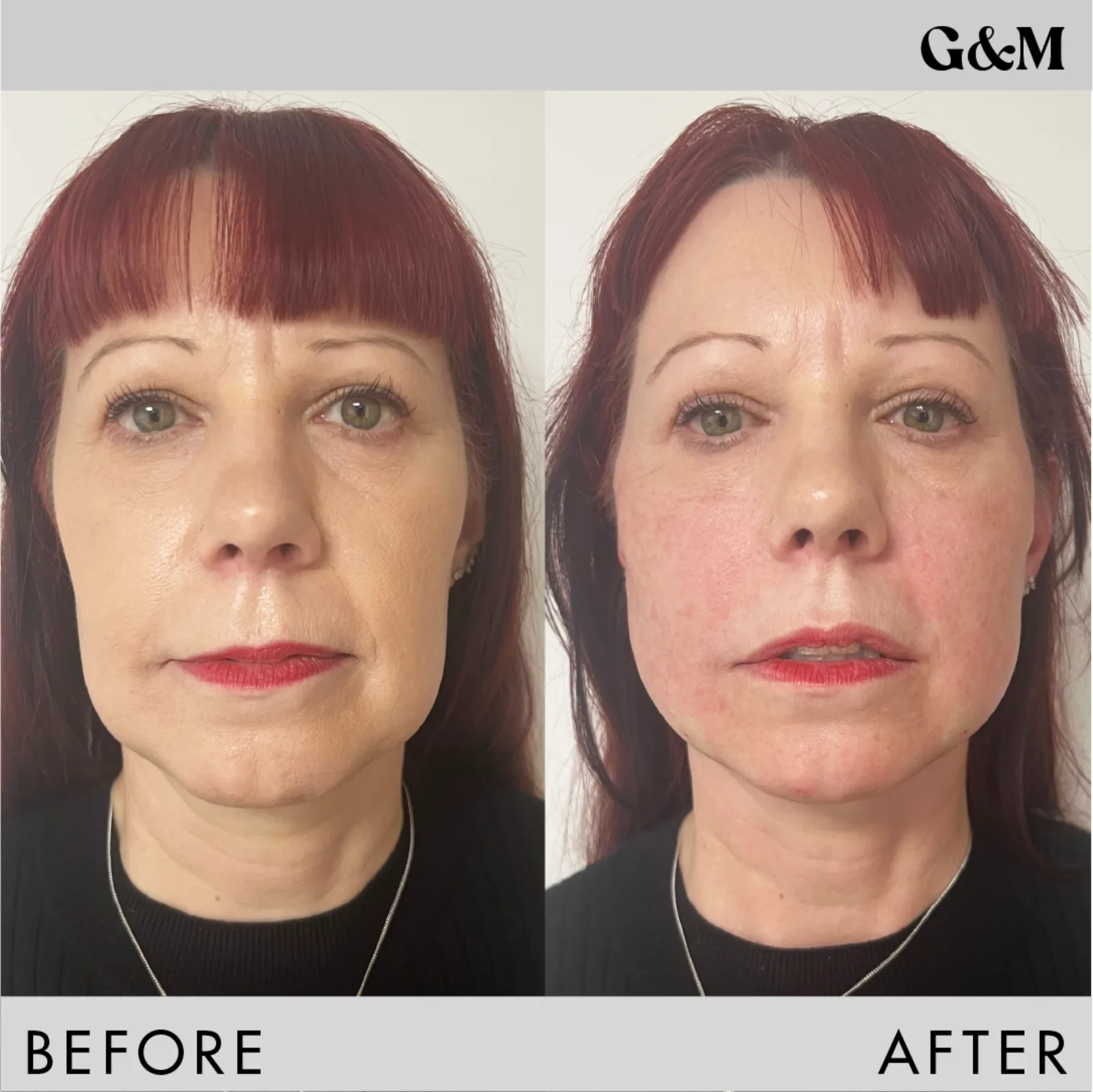 Before and after — PDO Mid and Lower Face