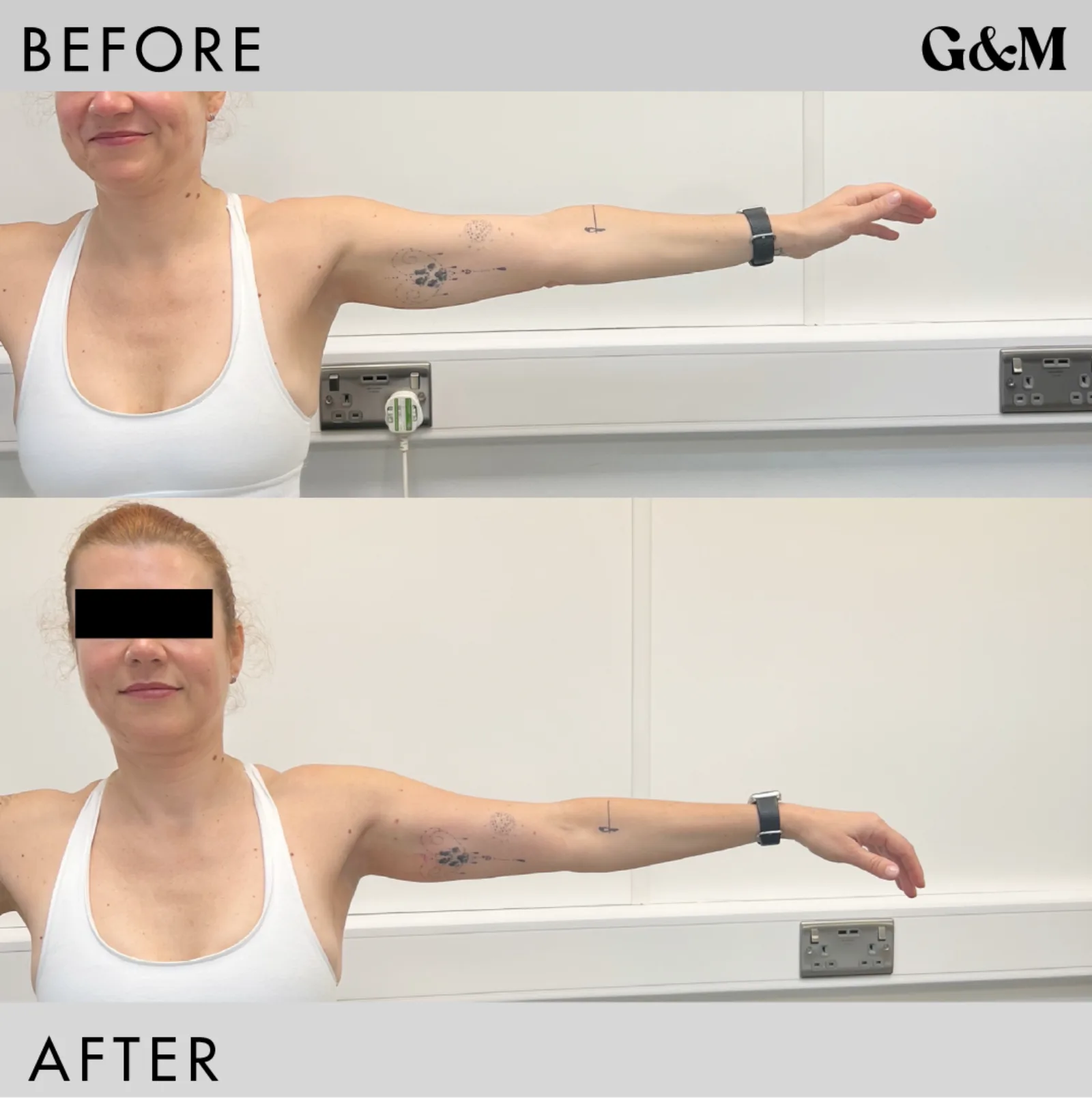 Before and after — PDO Body — upper arm