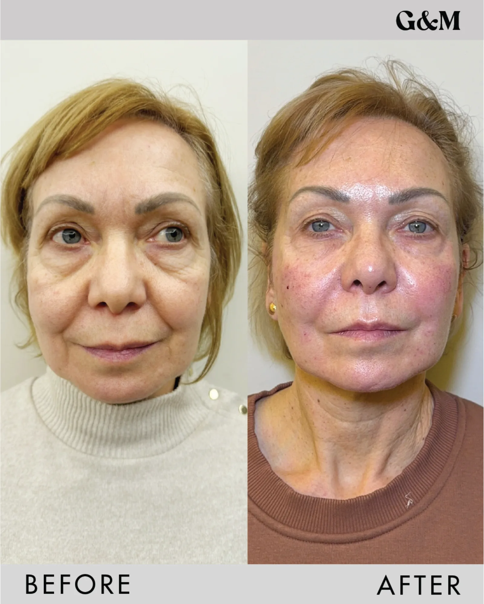 Before and after — PDO + Endolaser combined plan